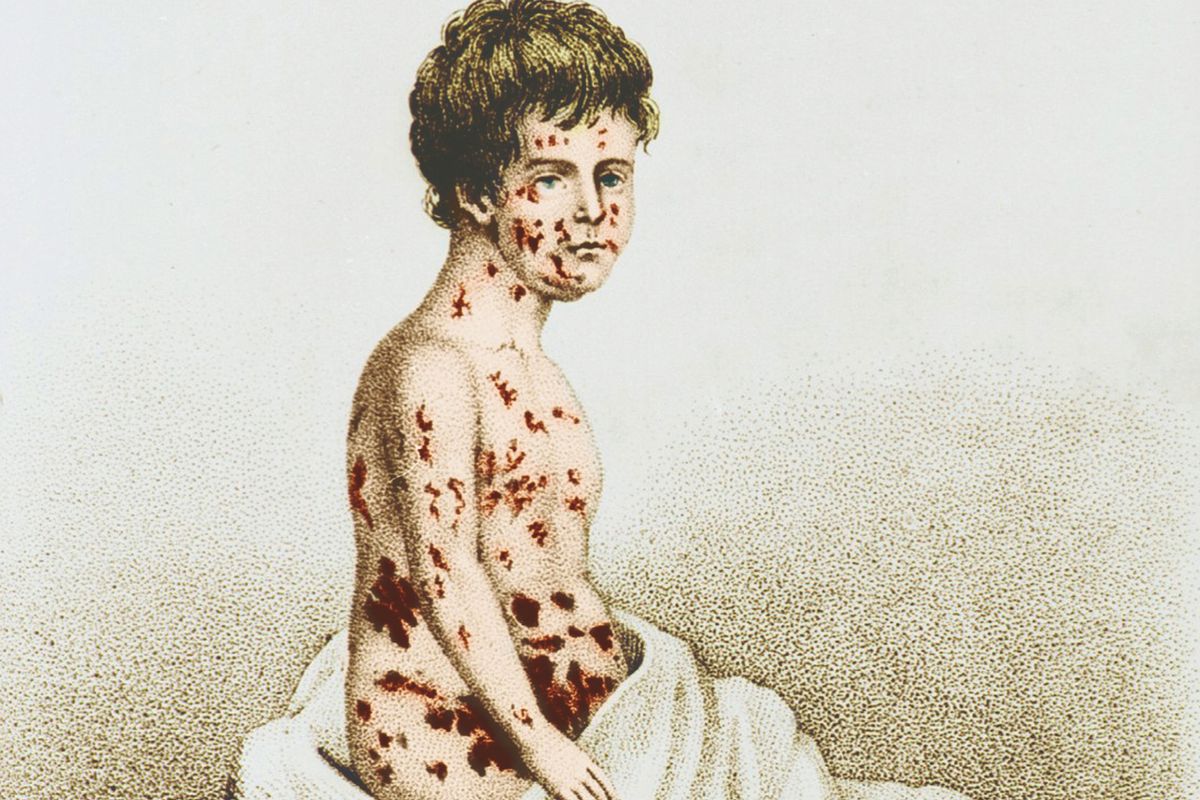 تاريخ مرض الجدري .. اكيف انتشر في العصور القديمة و من ابتكر لقاح الجدري ..